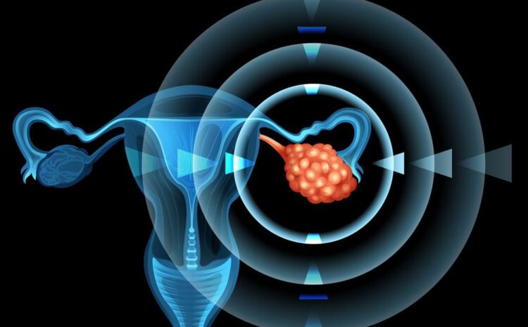  Cancerul Ovarian – tipuri; factori de risc; etape; diagnostic si tratament