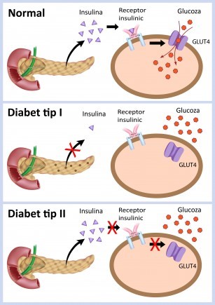 Diferenta dintre diabetul de tip 1 si diabetul de tip 2