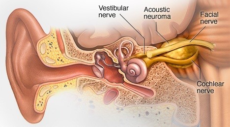 NEURINOMUL ACUSTIC sau SCHWANOMUL VESTIBULAR