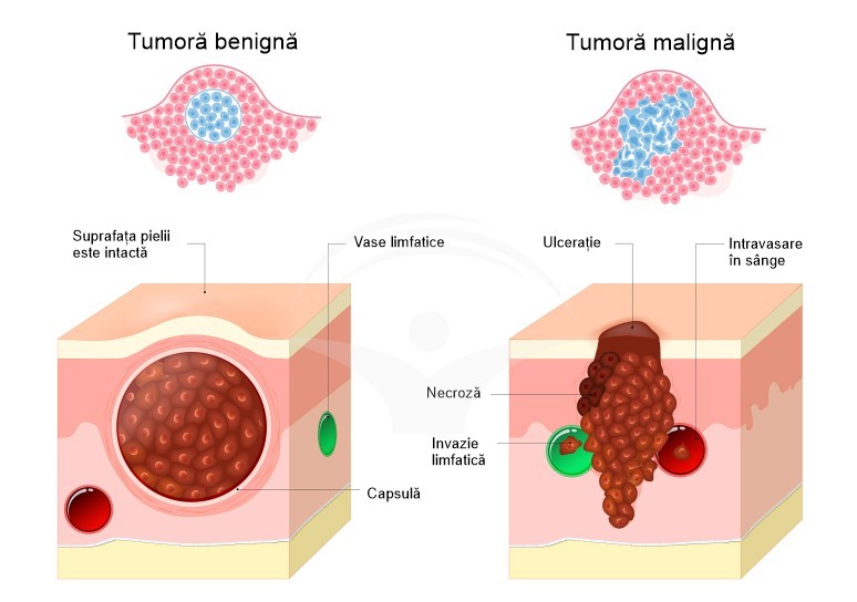 Cum diferențiem o tumoră cerebrală benignă de una malignă ?